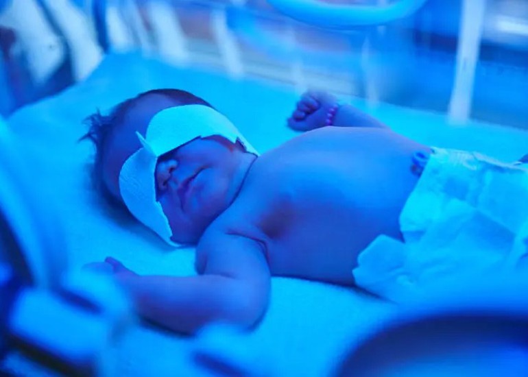 Newborn Jaundice Treatment 3 Newborn Jaundice Treatment 3
